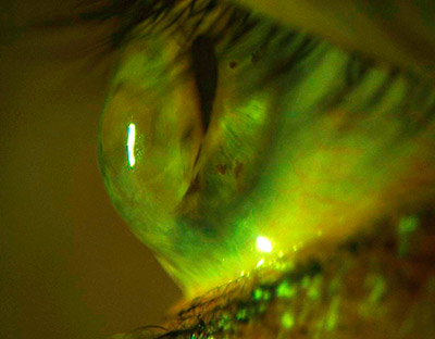 Lentillas rígidas top queratocono
